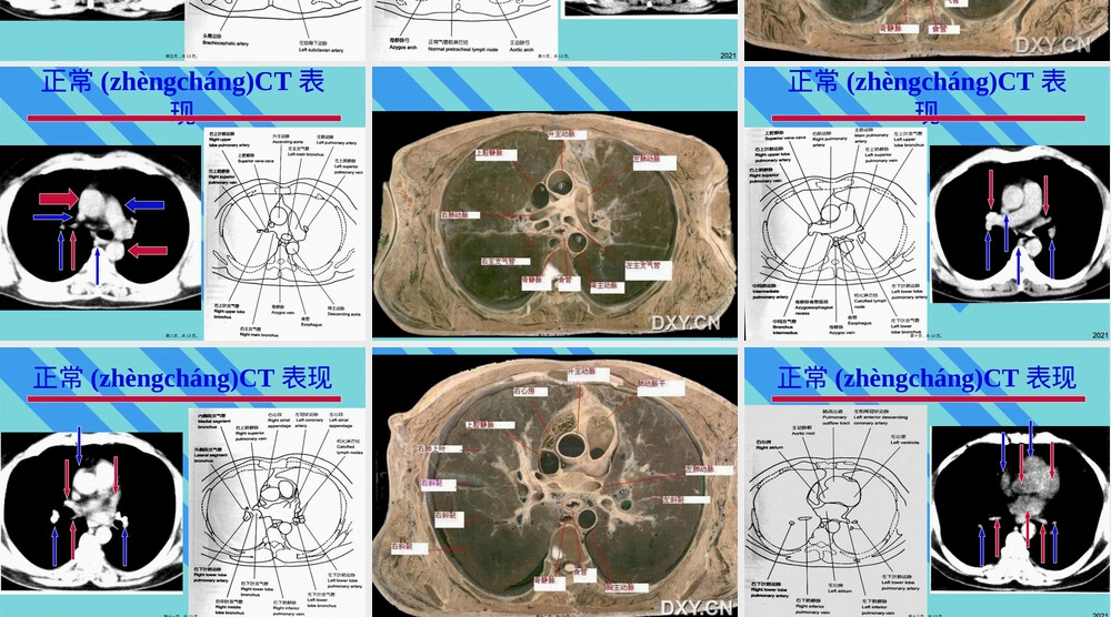 肺部正常CT影像教学PPT课件.pptx
