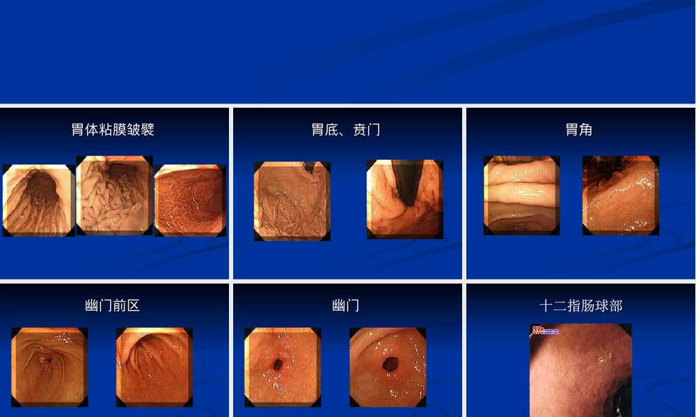 胃镜图谱正常与常见胃病PPT课件.ppt