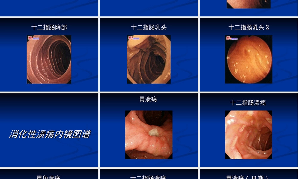 胃镜图谱PPT课件｜正常与常见胃病影像教学.ppt