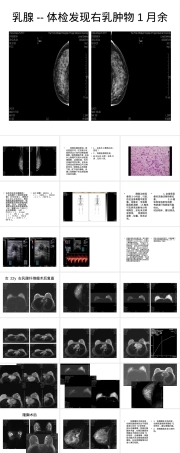 乳腺疾病临床病例分析PPT课件.ppt